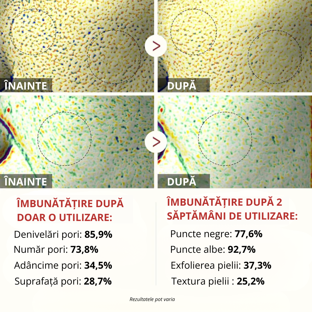 RALVINO - SER EXFOLIANT CONCENTRAT CU OREZ